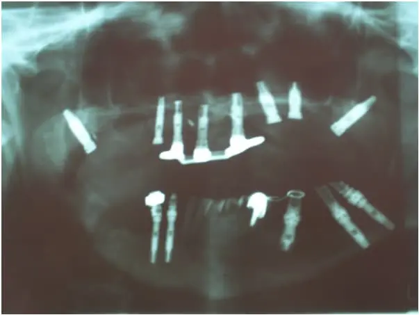 Parestesia por Implantodontia Tratada com Laseracupuntura