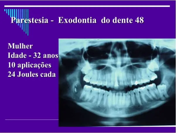 Apresentação sobre parestesia após exodontia do dente 48 em mulher de 32 anos, com 10 aplicações de 24 joules cada, incluindo foto de radiografia panorâmica da mandíbula.
