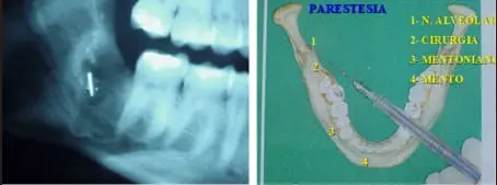 Radiografia periapical mostrando o dente 48 (terceiro molar inferior esquerdo) com raízes próximas ao canal do nervo alveolar inferior, após exodontia, e ilustração anatômica destacando parestesia na região alveolar (1), cirurgia (2), região da crurgia (3) e mento (4)